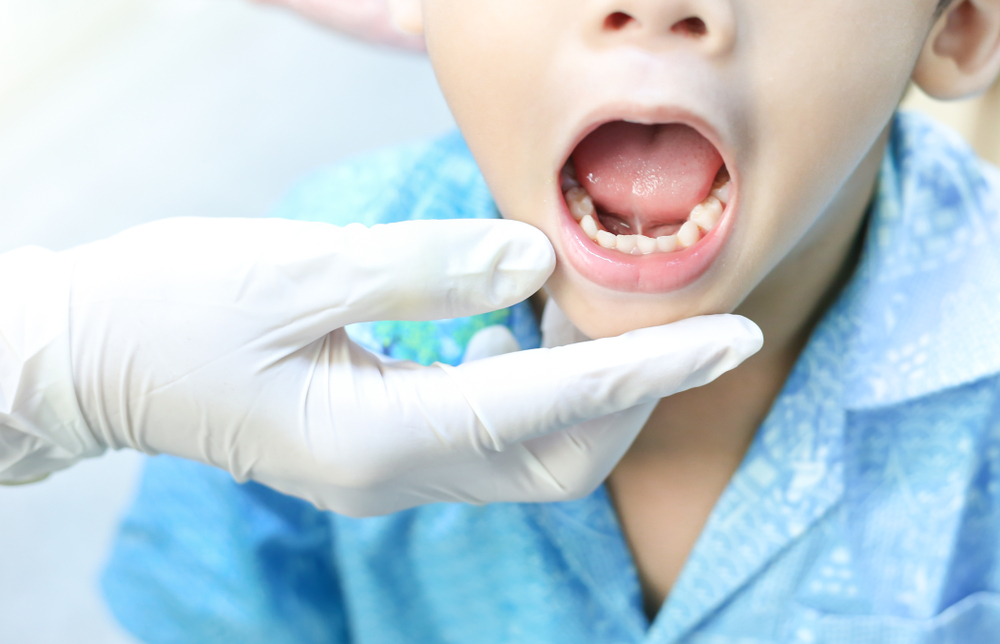 tongue ties vs lip ties what’s the difference and why it matters