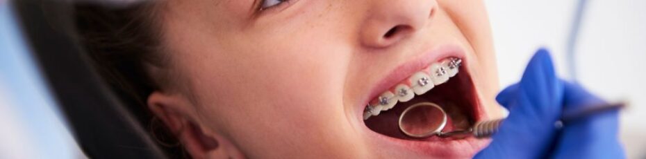 signs your child needs early orthodontic treatment